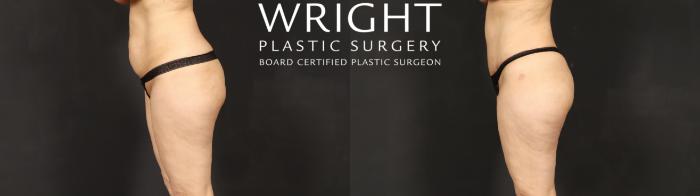 Before & After Tummy Tuck Case 609 Left Side View in Little Rock, Arkansas