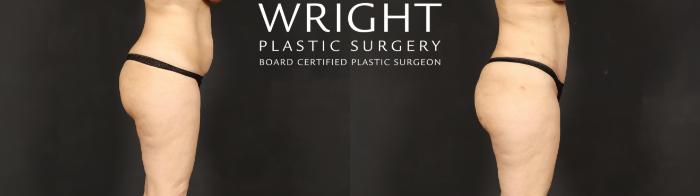 Before & After Tummy Tuck Case 609 Right Side View in Little Rock, Arkansas