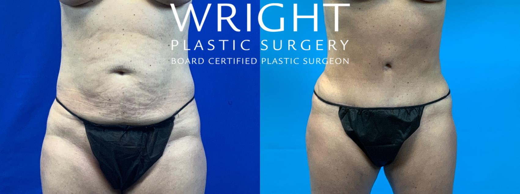 Tummy Tuck (Abdominoplasty) Little Rock & Fayetteville, AR