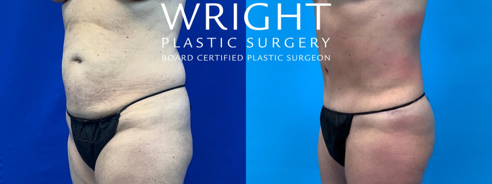 Before & After Tummy Tuck Case 61 Left Oblique View in Little Rock, Arkansas