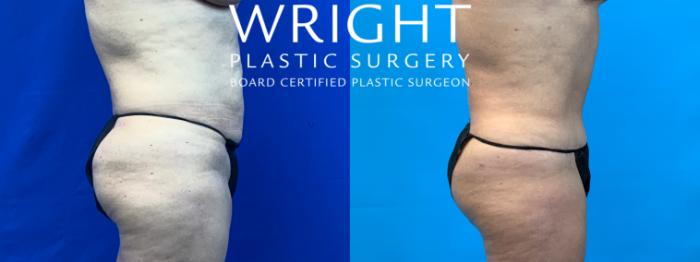 Before & After Tummy Tuck Case 61 Right Side View in Little Rock, Arkansas