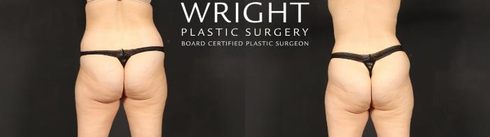 Before & After Tummy Tuck Case 621 Back View in Little Rock, Arkansas