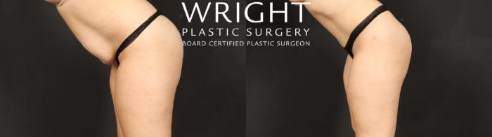 Before & After Tummy Tuck Case 621 Custom-Left Side View in Little Rock, Arkansas