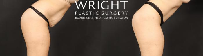 Before & After Tummy Tuck Case 621 Custom-Right Side View in Little Rock, Arkansas