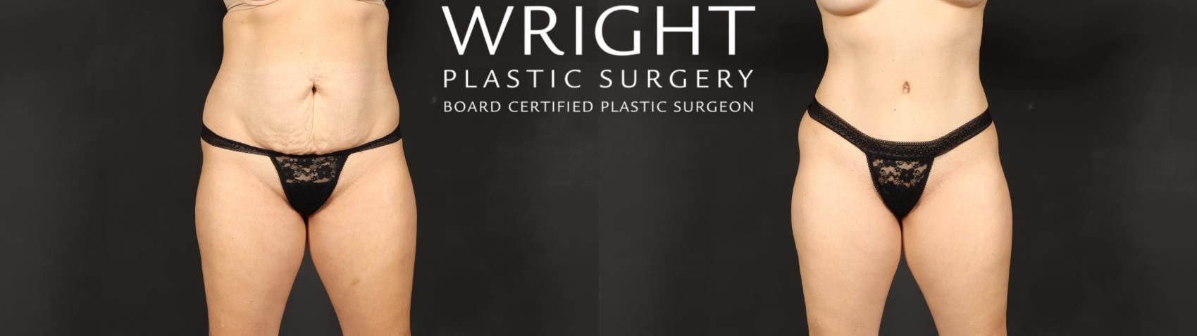 Before & After Tummy Tuck Case 621 Front View in Little Rock, Arkansas