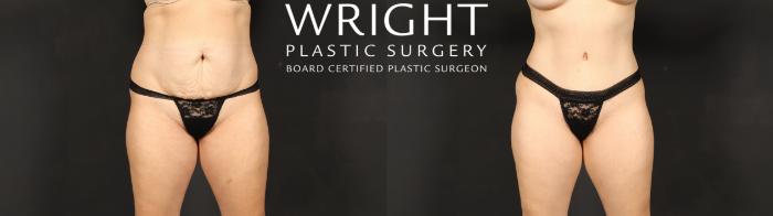 Before & After Tummy Tuck Case 621 Front View in Little Rock, Arkansas