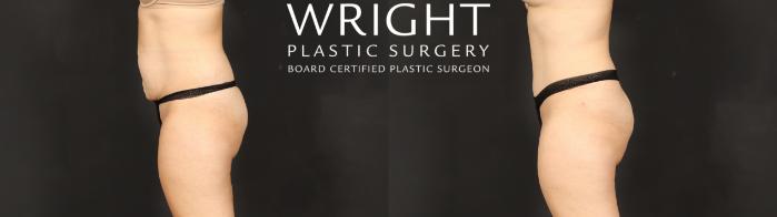 Before & After Tummy Tuck Case 621 Left Side View in Little Rock, Arkansas
