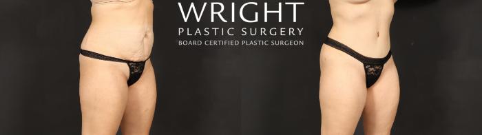 Before & After Tummy Tuck Case 621 Right Oblique View in Little Rock, Arkansas