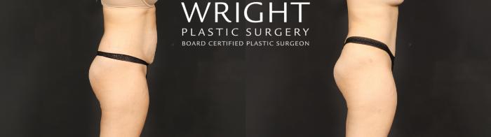 Before & After Tummy Tuck Case 621 Right Side View in Little Rock, Arkansas