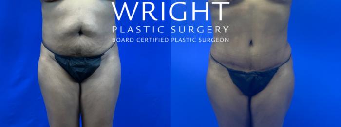 Before & After Tummy Tuck Case 63 Front View in Little Rock, Arkansas