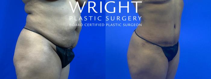Before & After Tummy Tuck Case 63 Right Oblique View in Little Rock, Arkansas