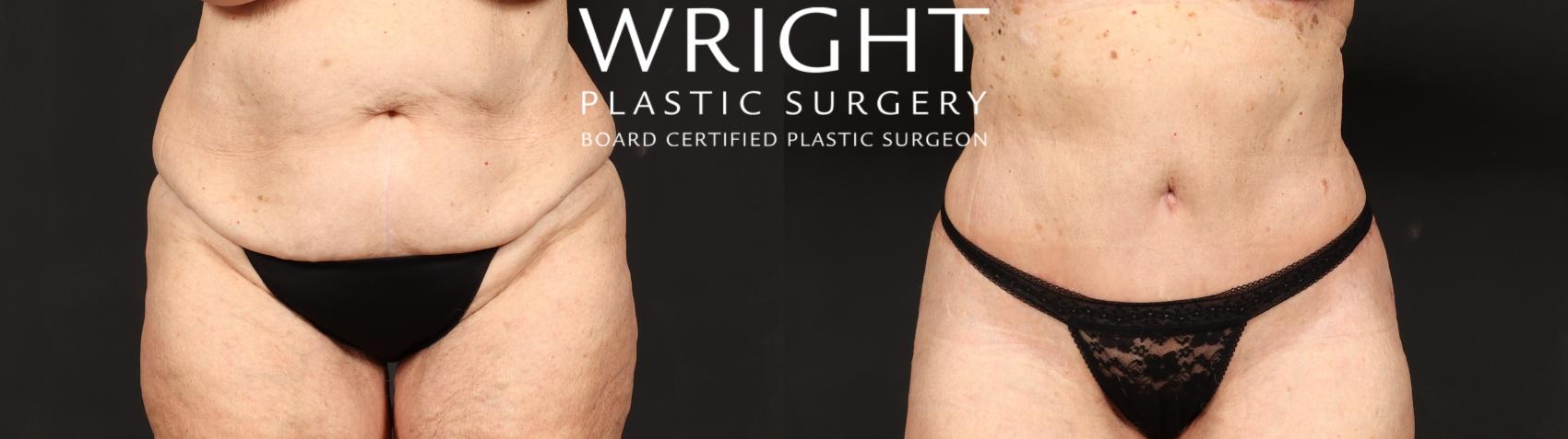 Before & After Tummy Tuck Case 631 Front View in Little Rock, Arkansas