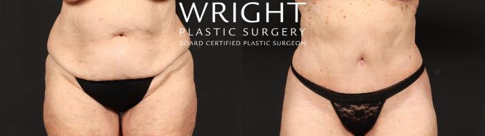 Before & After Tummy Tuck Case 631 Front View in Little Rock, Arkansas