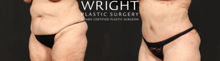 Before & After Tummy Tuck Case 631 Left Oblique View in Little Rock, Arkansas