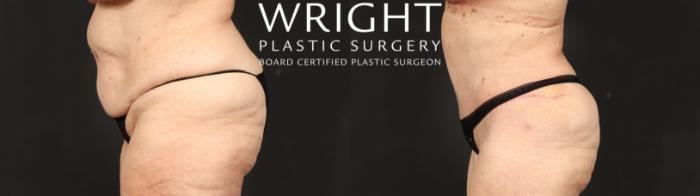 Before & After Tummy Tuck Case 631 Left Side View in Little Rock, Arkansas