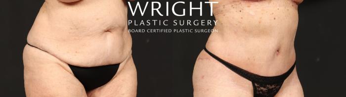 Before & After Tummy Tuck Case 631 Right Oblique View in Little Rock, Arkansas
