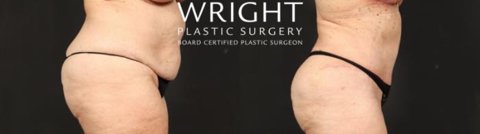 Before & After Tummy Tuck Case 631 Right Side View in Little Rock, Arkansas