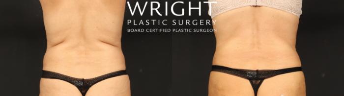 Before & After Tummy Tuck Case 635 Back View in Little Rock, Arkansas