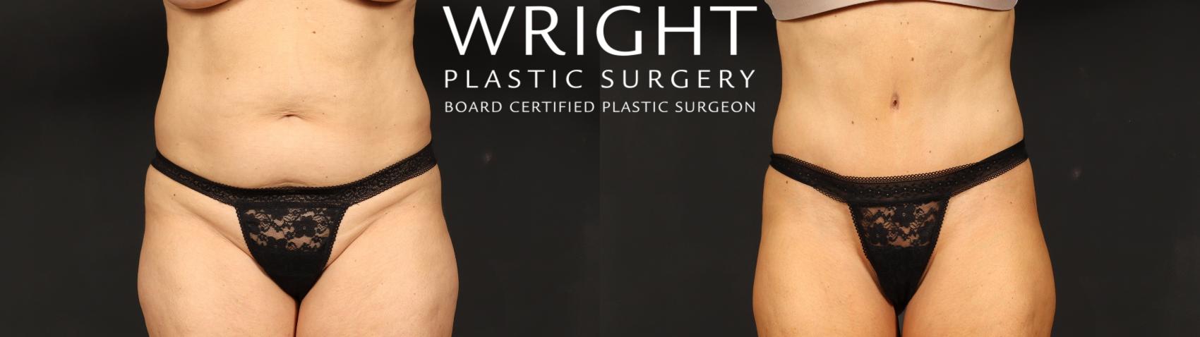 Before & After Tummy Tuck Case 635 Front View in Little Rock, Arkansas