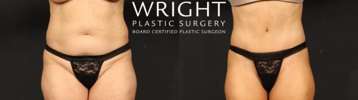 Before & After Tummy Tuck Case 635 Front View in Little Rock, Arkansas