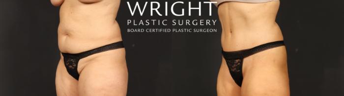 Before & After Tummy Tuck Case 635 Left Oblique View in Little Rock, Arkansas