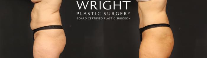 Before & After Tummy Tuck Case 635 Left Side View in Little Rock, Arkansas