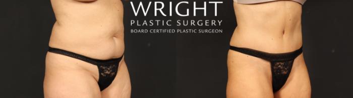 Before & After Tummy Tuck Case 635 Right Oblique View in Little Rock, Arkansas