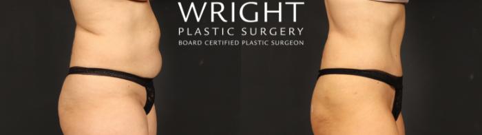 Before & After Tummy Tuck Case 635 Right Side View in Little Rock, Arkansas