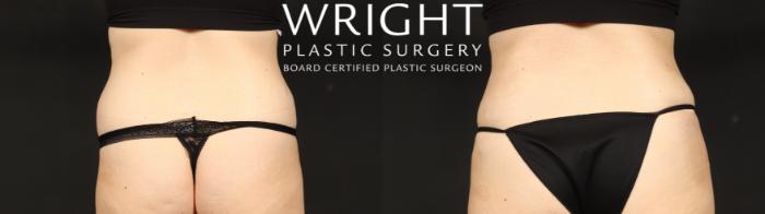 Before & After Tummy Tuck Case 640 Back View in Little Rock, Arkansas