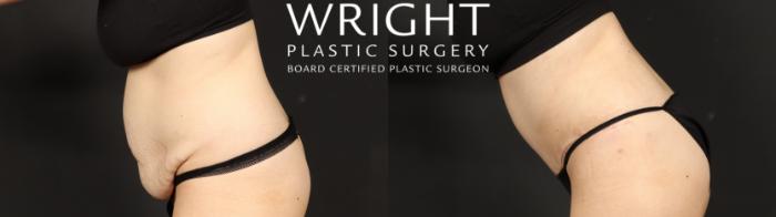 Before & After Tummy Tuck Case 640 Custom-Left Side View in Little Rock, Arkansas