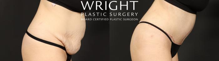 Before & After Tummy Tuck Case 640 Custom-Right Side View in Little Rock, Arkansas