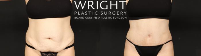 Before & After Tummy Tuck Case 640 Front View in Little Rock, Arkansas