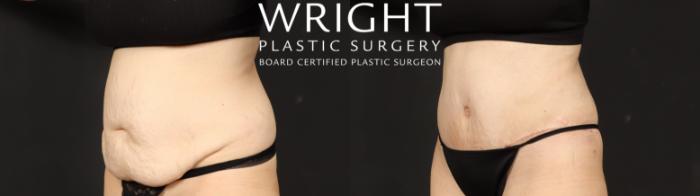 Before & After Tummy Tuck Case 640 Left Oblique View in Little Rock, Arkansas