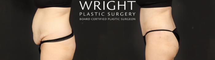 Before & After Tummy Tuck Case 640 Left Side View in Little Rock, Arkansas