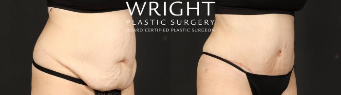 Before & After Tummy Tuck Case 640 Right Oblique View in Little Rock, Arkansas