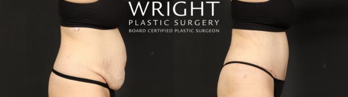 Before & After Tummy Tuck Case 640 Right Side View in Little Rock, Arkansas