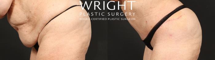 Before & After Tummy Tuck Case 646 Custom-Left Side View in Little Rock, Arkansas