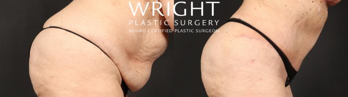 Before & After Tummy Tuck Case 646 Custom-Right Side View in Little Rock, Arkansas