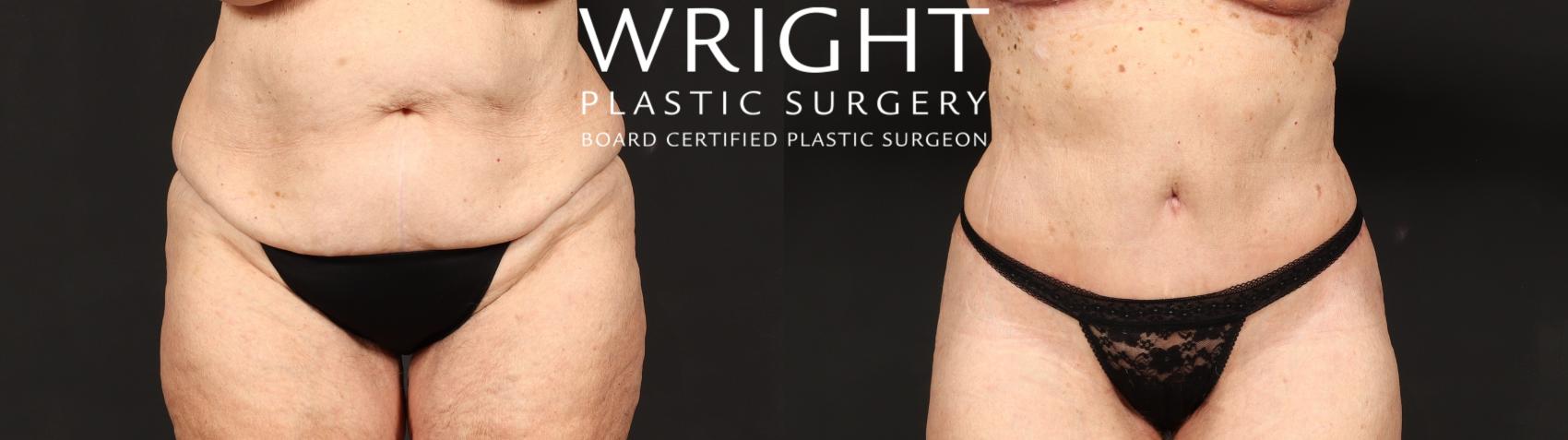 Before & After Tummy Tuck Case 646 Front View in Little Rock, Arkansas