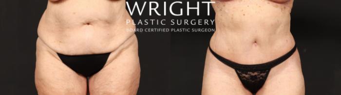Before & After Tummy Tuck Case 646 Front View in Little Rock, Arkansas