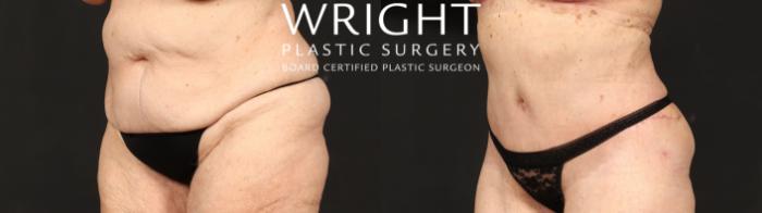 Before & After Tummy Tuck Case 646 Left Oblique View in Little Rock, Arkansas