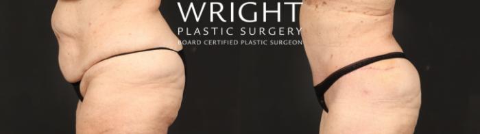 Before & After Tummy Tuck Case 646 Left Side View in Little Rock, Arkansas