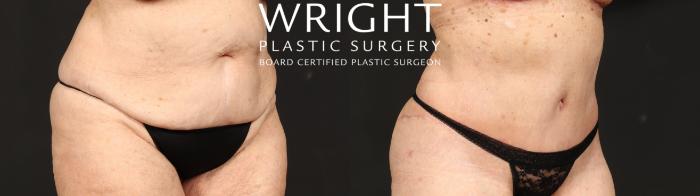 Before & After Tummy Tuck Case 646 Right Oblique View in Little Rock, Arkansas