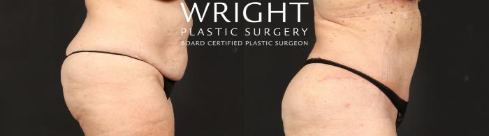 Before & After Tummy Tuck Case 646 Right Side View in Little Rock, Arkansas