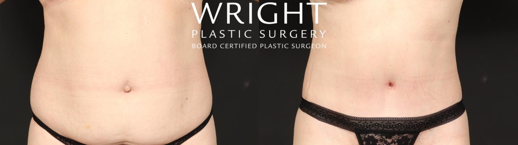 Before & After Tummy Tuck Case 649 Front View in Little Rock, Arkansas