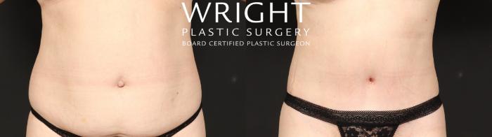 Before & After Tummy Tuck Case 649 Front View in Little Rock, Arkansas