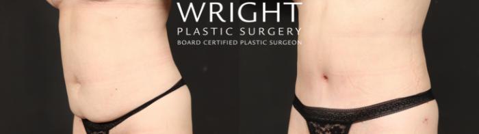 Before & After Tummy Tuck Case 649 Left Oblique View in Little Rock, Arkansas
