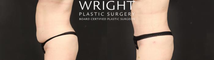 Before & After Tummy Tuck Case 649 Left Side View in Little Rock, Arkansas
