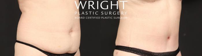 Before & After Tummy Tuck Case 649 Right Oblique View in Little Rock, Arkansas