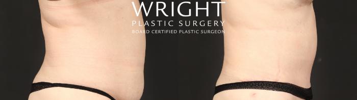 Before & After Tummy Tuck Case 649 Right Side View in Little Rock, Arkansas